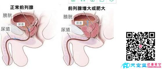 經尿道前列腺等離子雙極電切術動畫視頻d.jpg