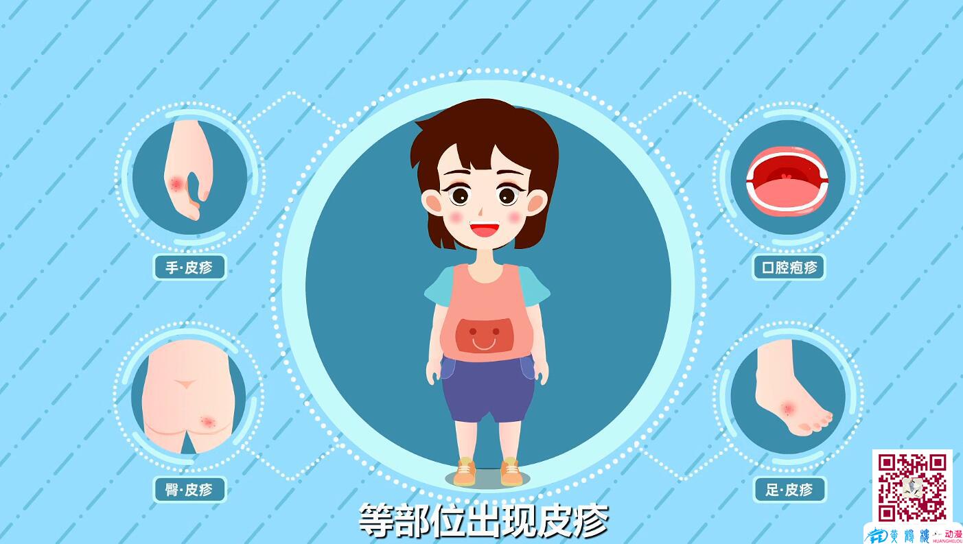 手足口病防治小知識早期癥狀身體.jpg 手足口病防治小知識早期癥狀身體.jpg