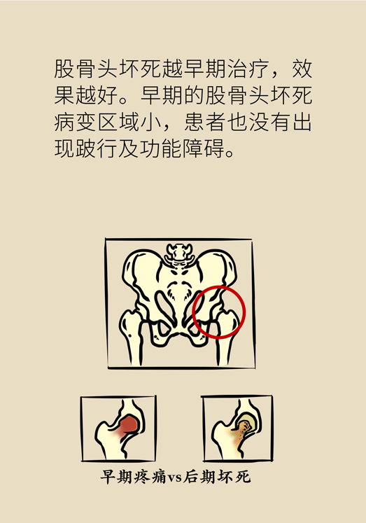 激素會帶來股骨頭壞死的后遺癥嗎？