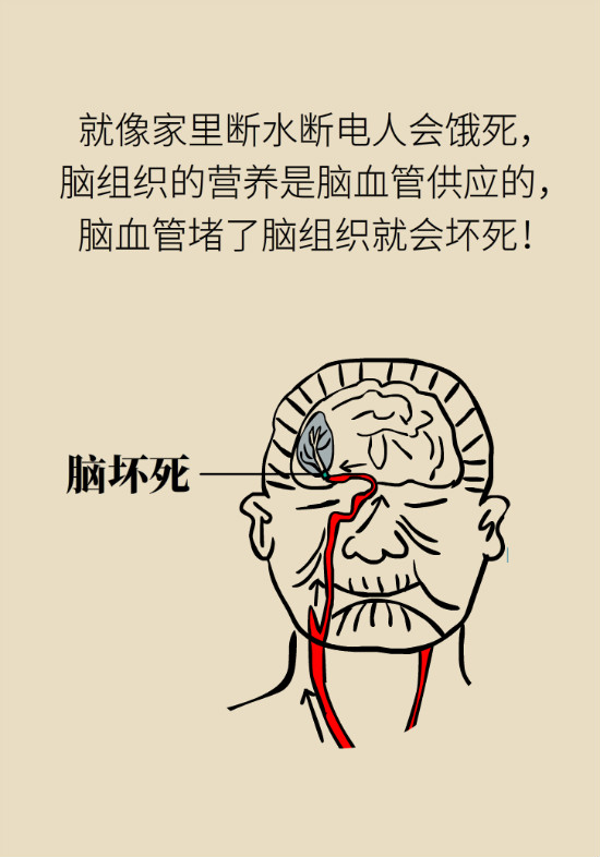 腔隙性腦梗死一定是腦血管堵了嗎？