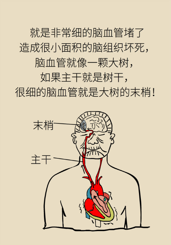 腔隙性腦梗死一定是腦血管堵了嗎？