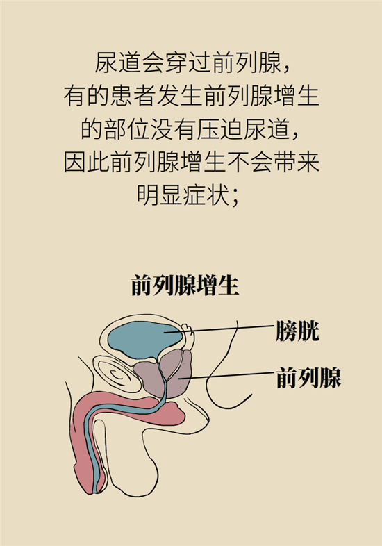 前列腺肥大了還能縮小嗎？