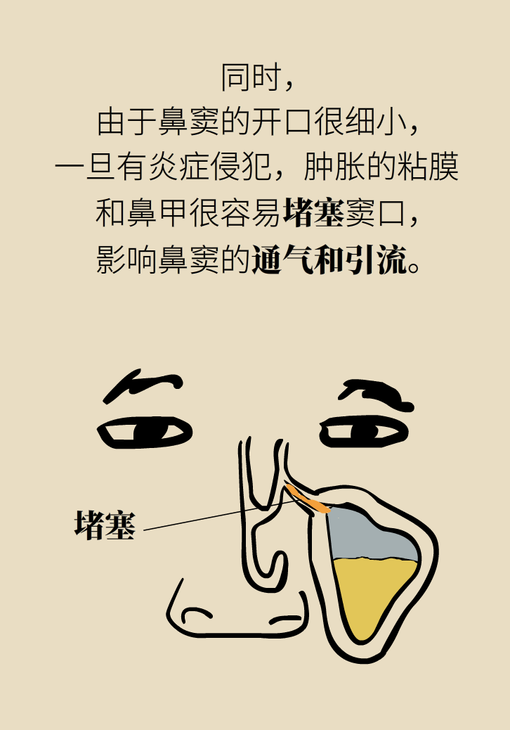 為什么鼻竇發(fā)炎，疼的卻是頭、眼和牙？