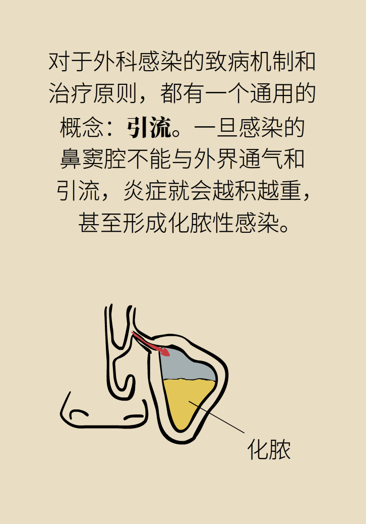 為什么鼻竇發(fā)炎，疼的卻是頭、眼和牙？