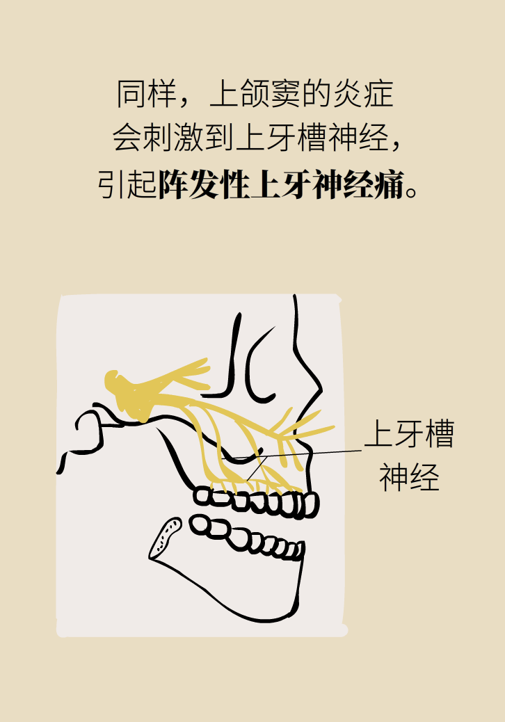 為什么鼻竇發(fā)炎，疼的卻是頭、眼和牙？