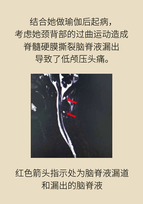 練瑜伽把腦脊液拉漏了！常見的“瑜伽病”你知道多少