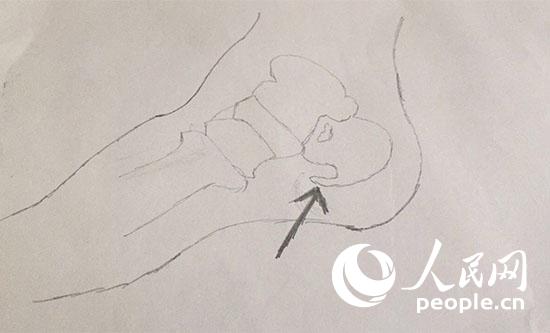 腿腳疼痛就買膏藥治骨刺？別被不良商家誤導(dǎo)了