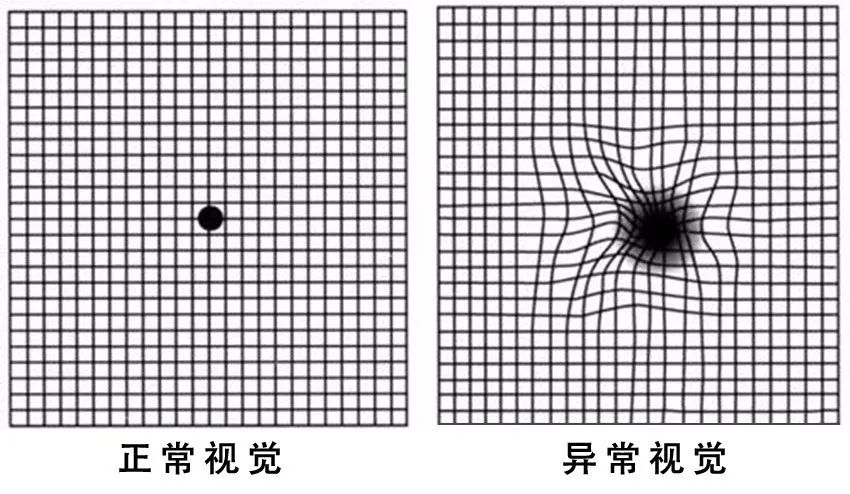 糖尿病患者出現(xiàn)這個(gè)癥狀，可能是失明前兆
