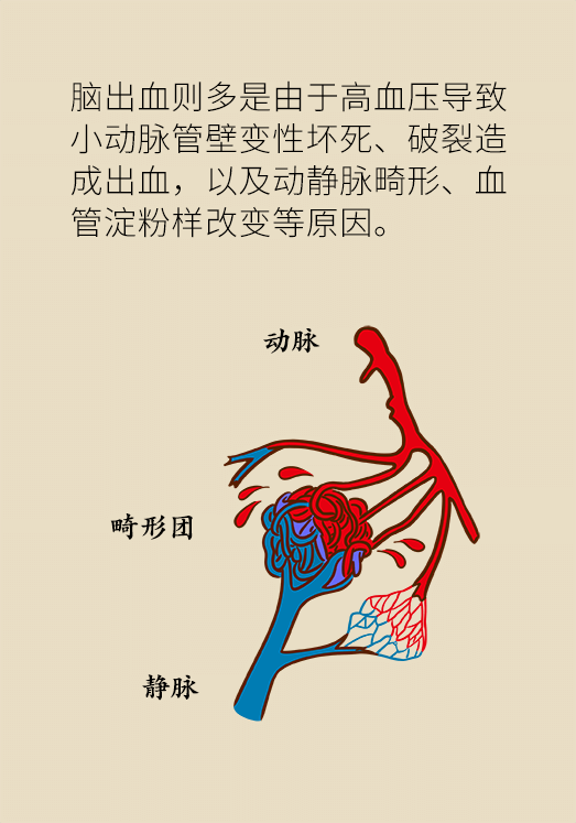 腦出血怎么辦？這些人群要格外注意