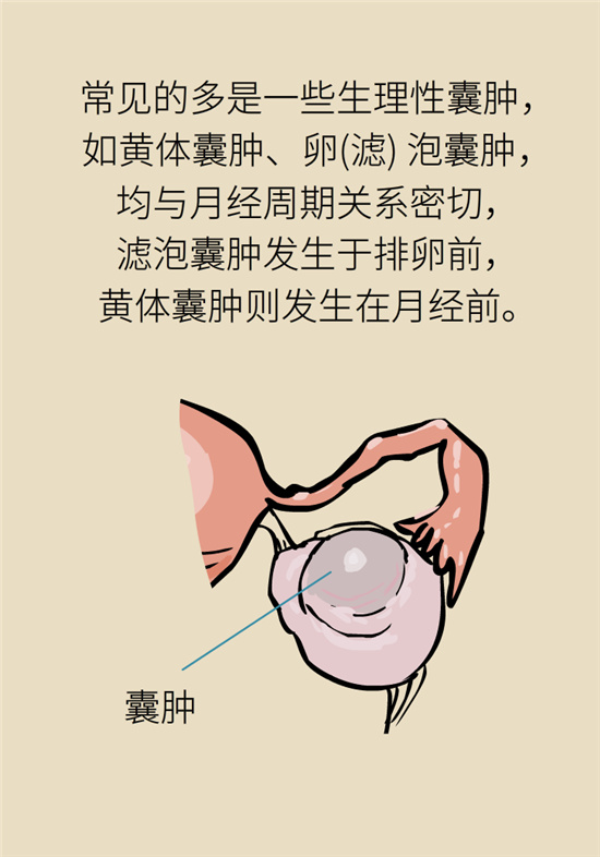 卵巢囊腫科普動漫：卵巢囊腫是腫瘤嗎？要學(xué)會這樣區(qū)分