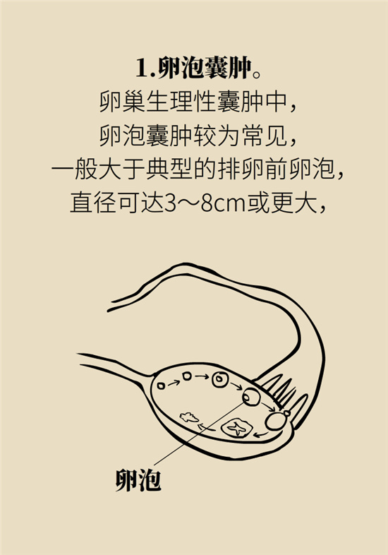 卵巢囊腫科普動漫：卵巢囊腫是腫瘤嗎？要學(xué)會這樣區(qū)分