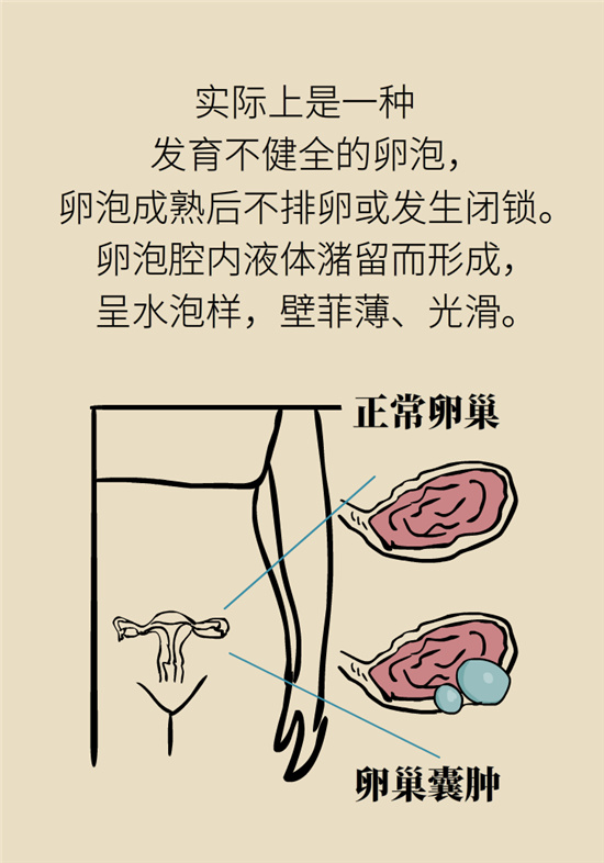 卵巢囊腫科普動漫：卵巢囊腫是腫瘤嗎？要學(xué)會這樣區(qū)分