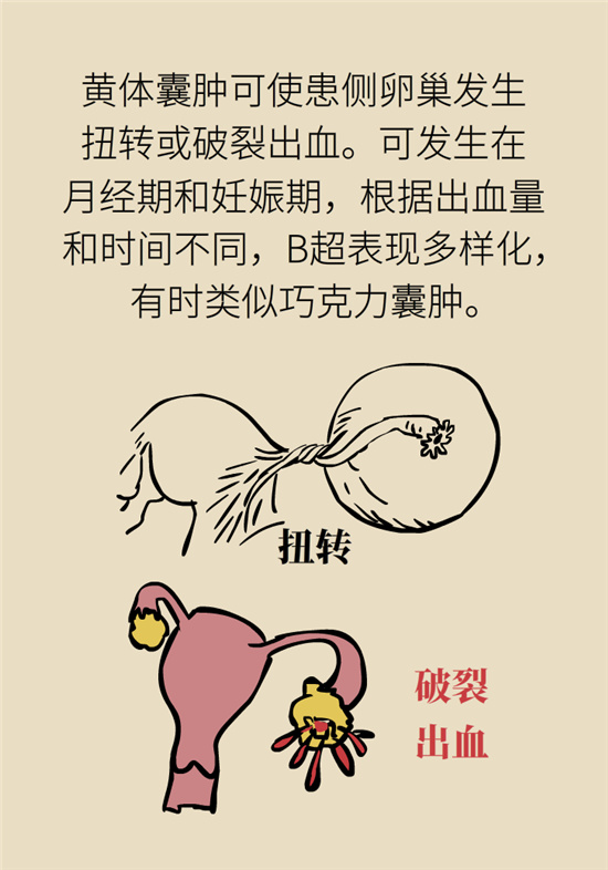 卵巢囊腫科普動漫：卵巢囊腫是腫瘤嗎？要學(xué)會這樣區(qū)分