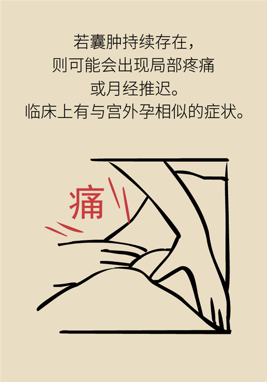 卵巢囊腫科普動漫：卵巢囊腫是腫瘤嗎？要學(xué)會這樣區(qū)分
