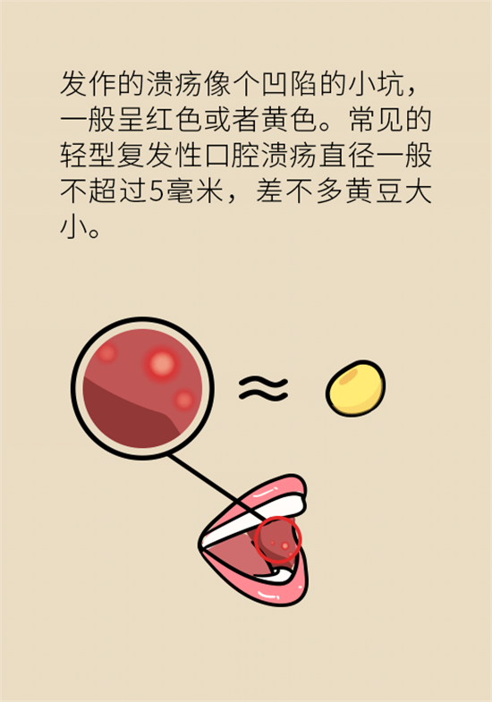 口腔潰瘍還想約火鍋？這四種情況一定要高度警惕