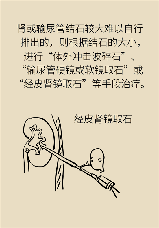 結(jié)石科普：身體里多了各種結(jié)石，應(yīng)該怎么辦？