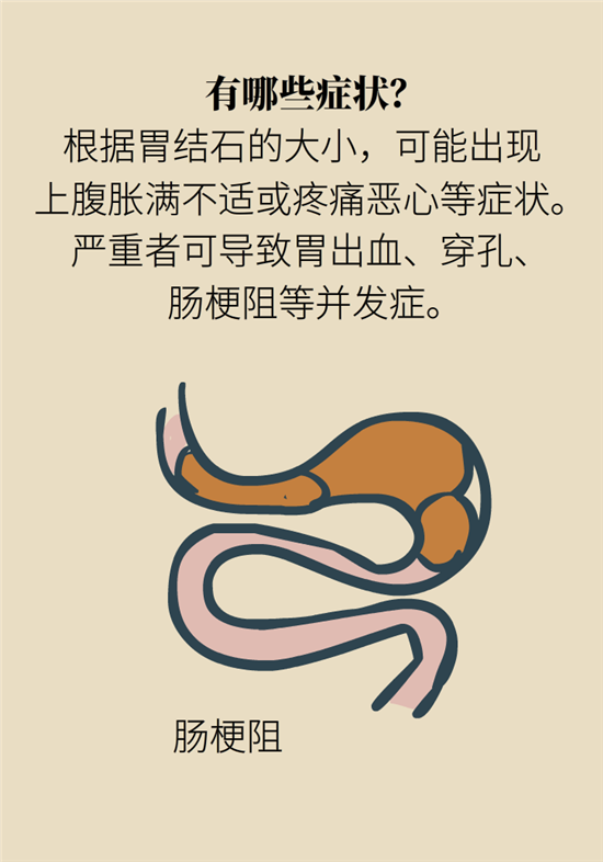 結(jié)石科普：身體里多了各種結(jié)石，應(yīng)該怎么辦？