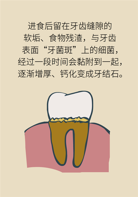 結(jié)石科普：身體里多了各種結(jié)石，應(yīng)該怎么辦？