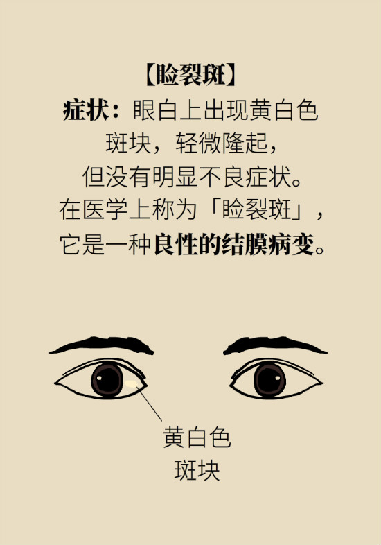 眼白有斑塊、出血要緊嗎？專家：名字唬人但問題不大