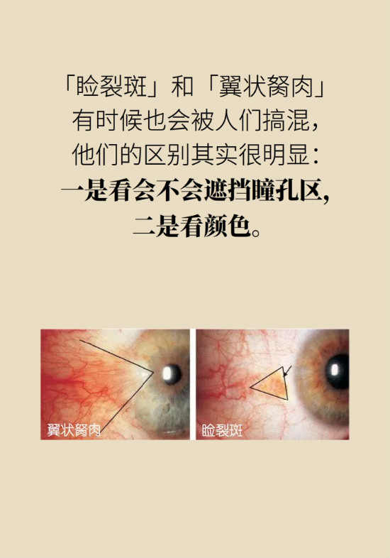 眼白有斑塊、出血要緊嗎？專家：名字唬人但問題不大
