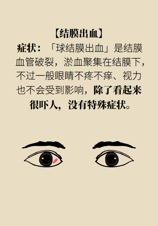 眼白有斑塊、出血要緊嗎？專家：名字唬人但問題不大