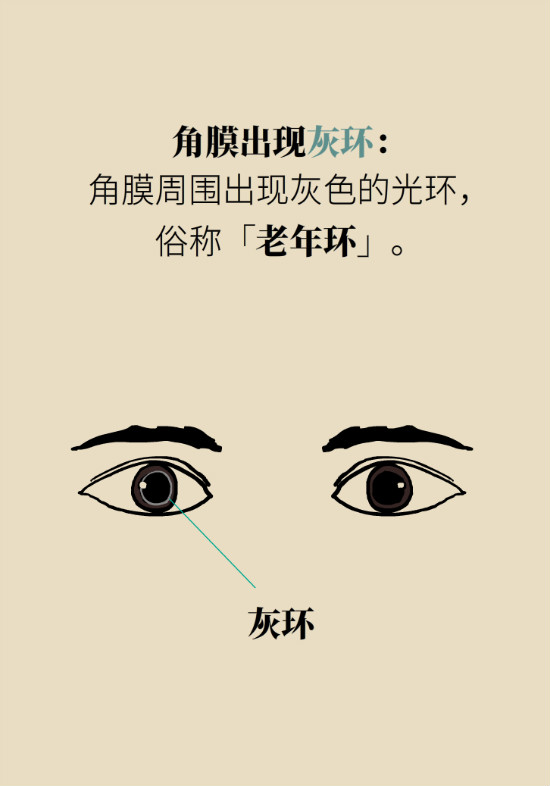 眼白有斑塊、出血要緊嗎？專家：名字唬人但問題不大