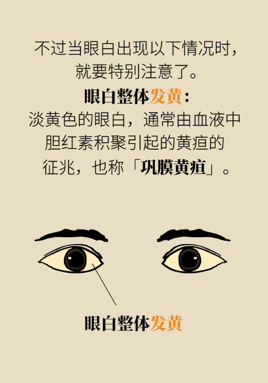 眼白有斑塊、出血要緊嗎？專家：名字唬人但問題不大