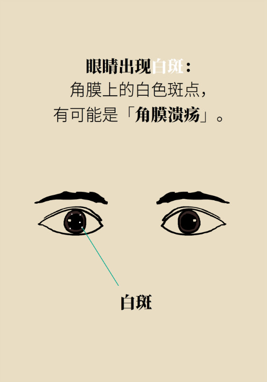 眼白有斑塊、出血要緊嗎？專家：名字唬人但問題不大