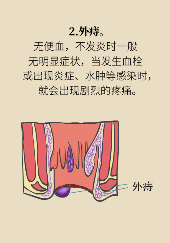 長“痔”如何久安？專家的建議來了