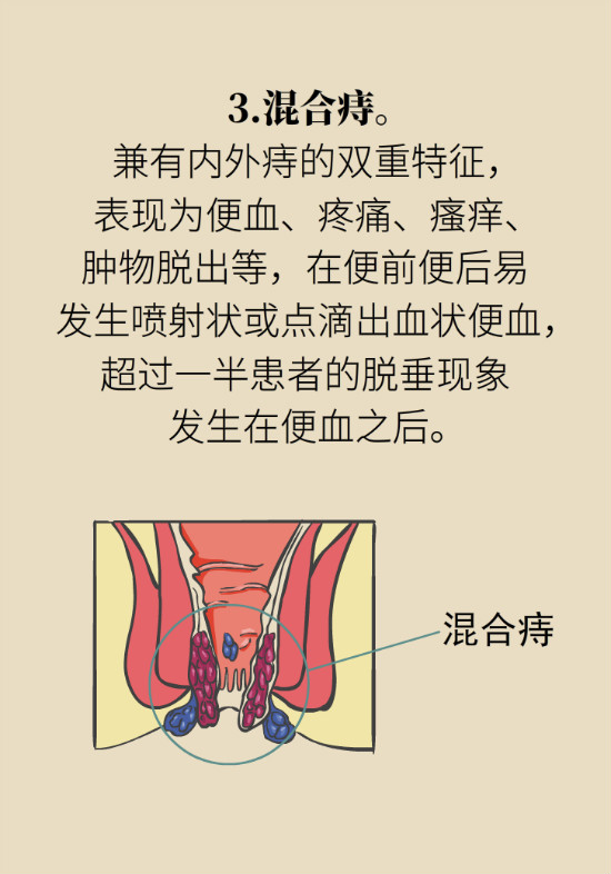 長“痔”如何久安？專家的建議來了