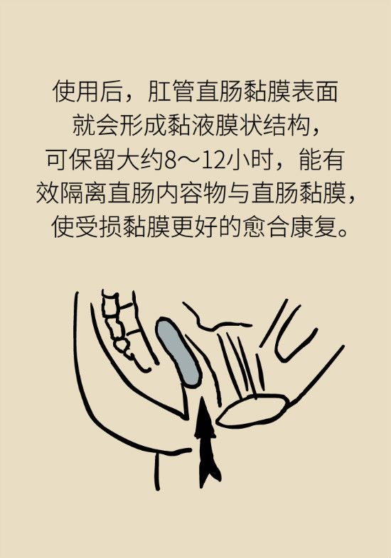 長“痔”如何久安？專家的建議來了