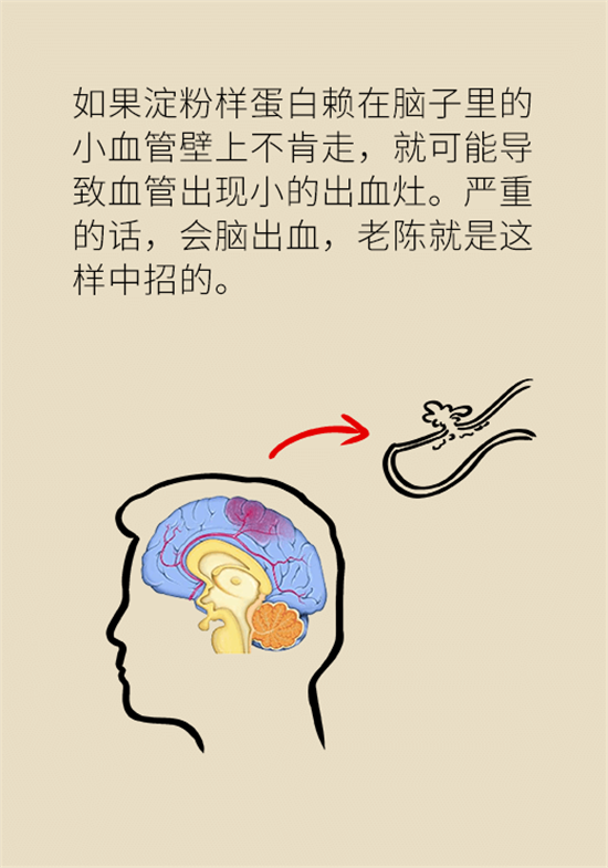 身體出現(xiàn)這些癥狀要小心，可能是腦出血發(fā)出的信號(hào)