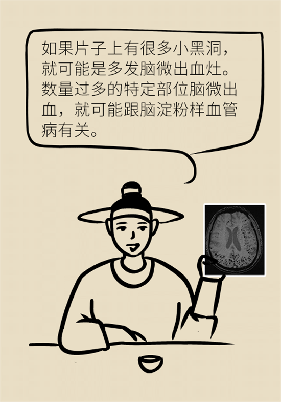 身體出現(xiàn)這些癥狀要小心，可能是腦出血發(fā)出的信號(hào)