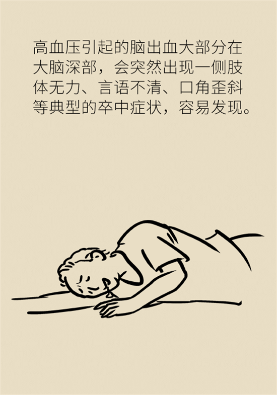 身體出現(xiàn)這些癥狀要小心，可能是腦出血發(fā)出的信號(hào)