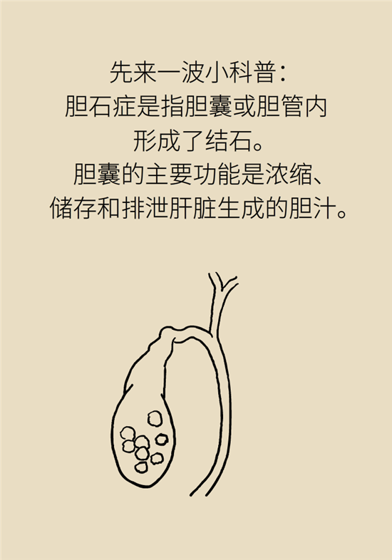 膽結(jié)石主要成分竟是膽固醇？預(yù)防它只需四個(gè)字