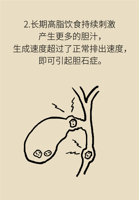 膽結(jié)石主要成分竟是膽固醇？預(yù)防它只需四個(gè)字