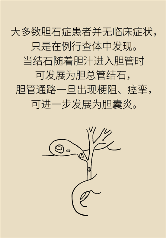 膽結(jié)石主要成分竟是膽固醇？預(yù)防它只需四個(gè)字