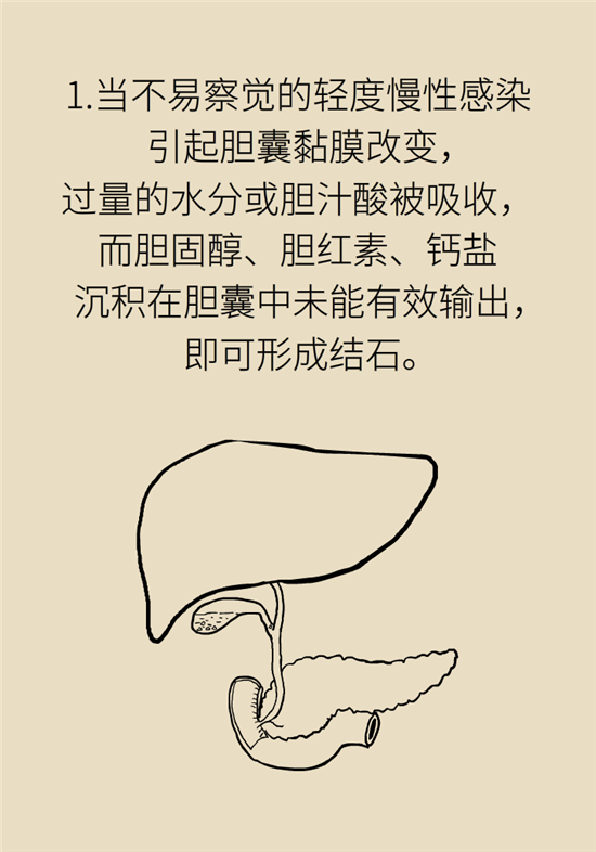 膽結(jié)石主要成分竟是膽固醇？預(yù)防它只需四個(gè)字