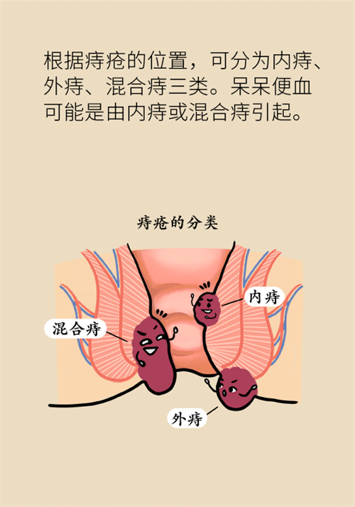 肛門(mén)腫脹還有血？小心痔瘡找上門(mén)