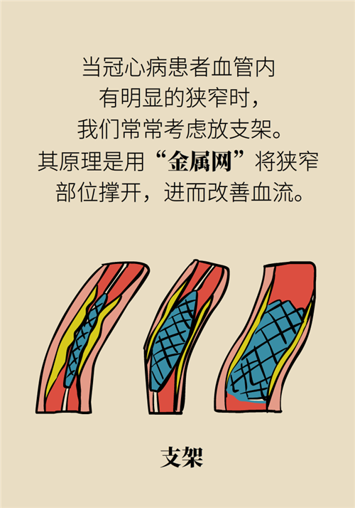 為什么裝完支架猝死風(fēng)險(xiǎn)還增高了？都是因?yàn)檫@些壞習(xí)慣