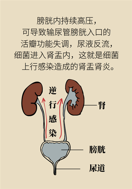 經(jīng)常憋尿會得急性腎炎？