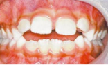 兒童換牙常見3大問題，保護(hù)牙齒需要做好這5點(diǎn)
