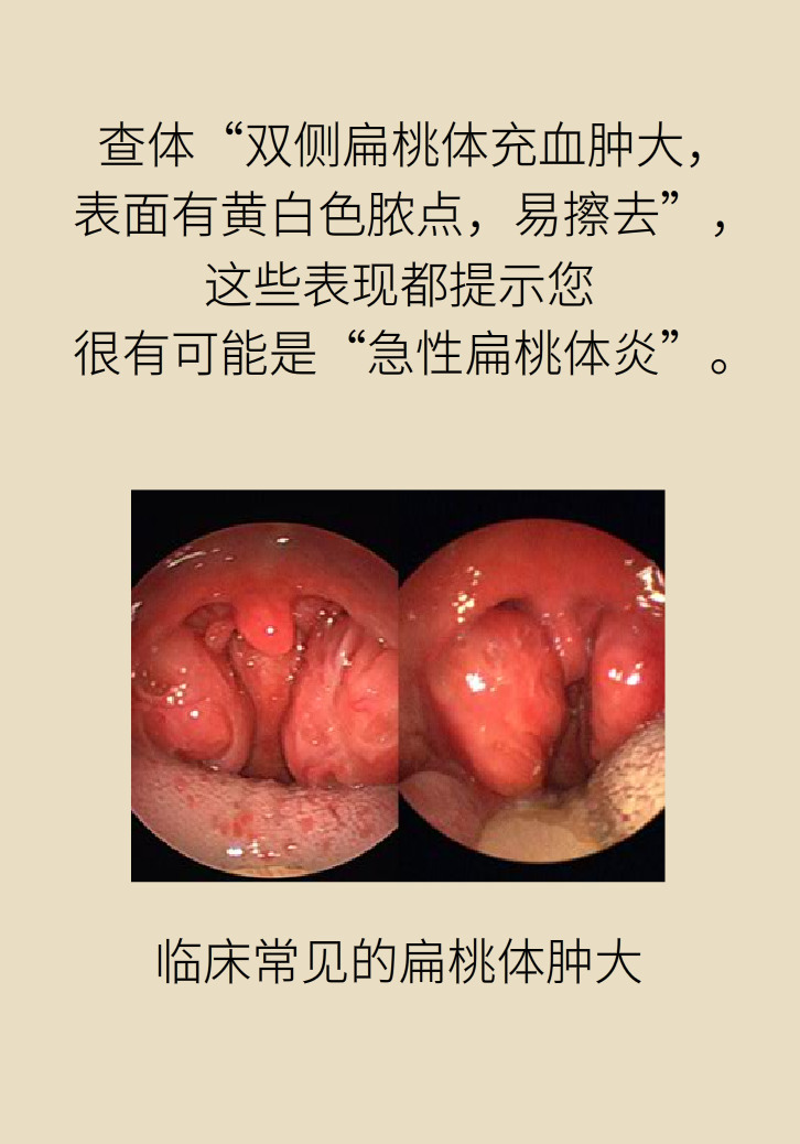 單側(cè)扁桃體腫大更兇險(xiǎn)！謹(jǐn)防惡性腫瘤