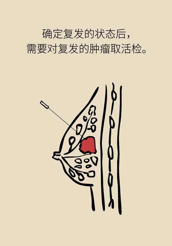 乳腺癌復(fù)發(fā)、轉(zhuǎn)移了怎么辦？
