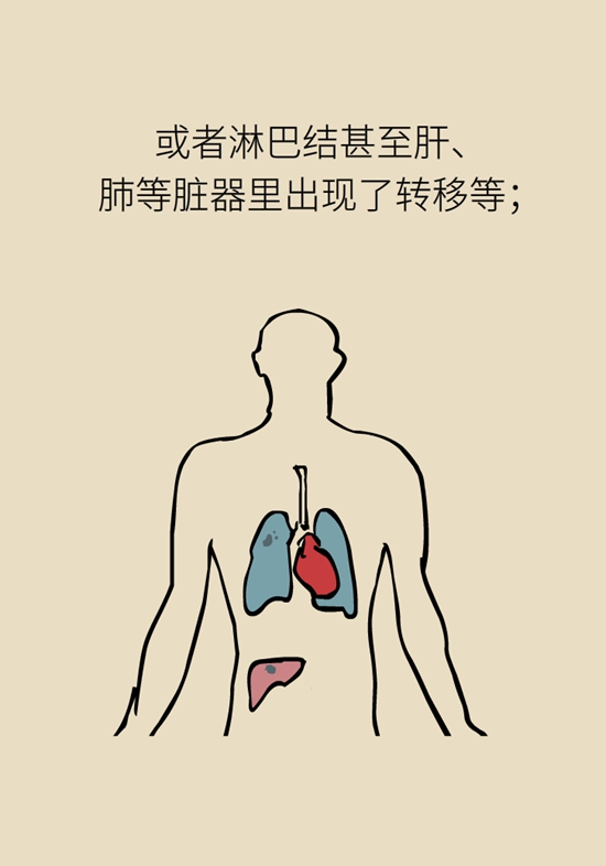 乳腺癌復(fù)發(fā)、轉(zhuǎn)移了怎么辦？