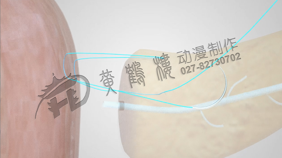武漢醫(yī)療動(dòng)畫(huà)演示制作公司.jpg 武漢醫(yī)療動(dòng)畫(huà)演示制作公司.jpg