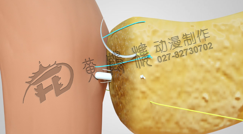 武漢醫(yī)療手術(shù)演示動(dòng)畫(huà)制作.jpg 武漢醫(yī)療手術(shù)演示動(dòng)畫(huà)制作.jpg