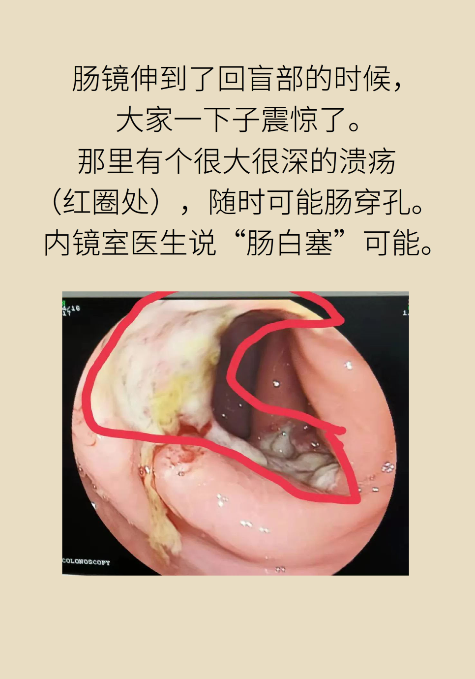 長白塞病醫(yī)學(xué)知識科普動畫制作
