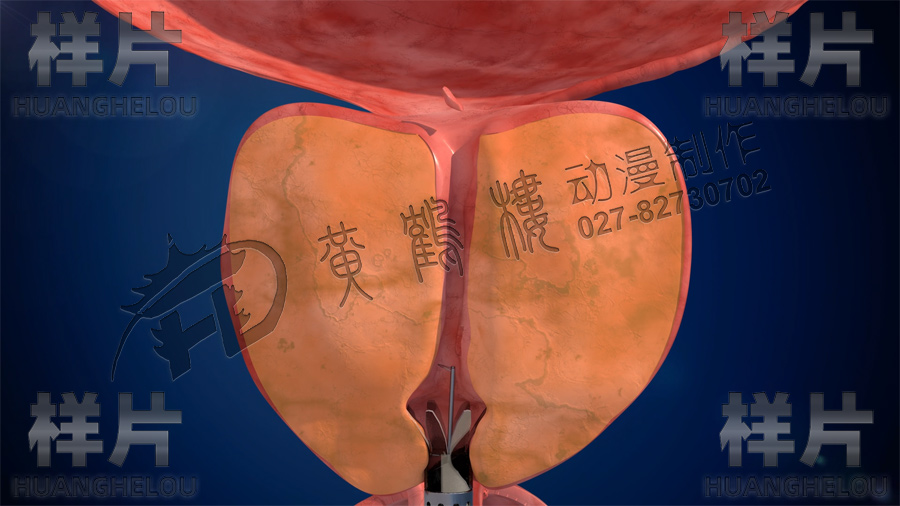 醫(yī)療手術(shù)動畫視頻 醫(yī)療手術(shù)動畫視頻