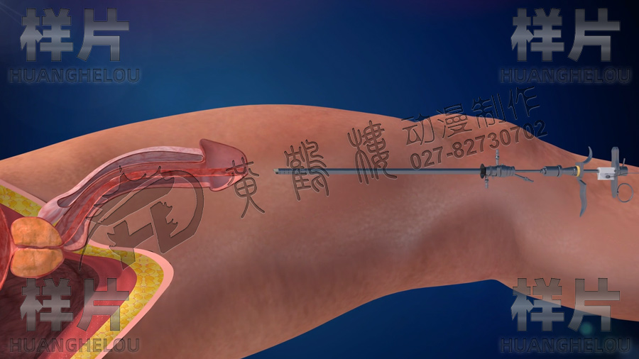 前列腺手術(shù)動畫視頻 前列腺手術(shù)動畫視頻